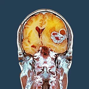 Brain cancer, MRI scan C016 / 4436