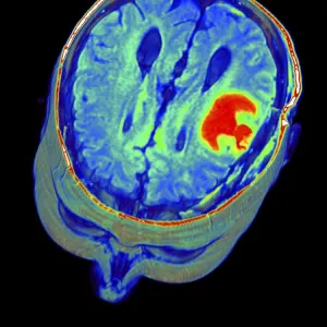 Brain tumour, 3D-MRI scan