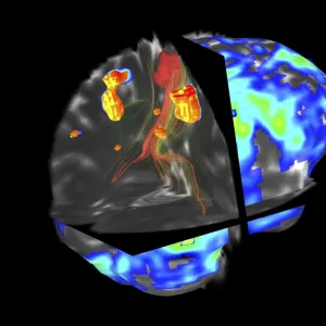 Brain tumour, fMRI and tractography C017 / 7102