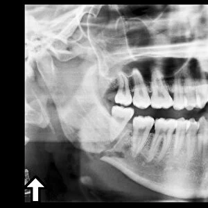 Broken jaw, X-ray C017 / 7557
