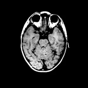 Childs brain, MRI scan