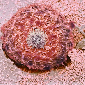 Colorectal cancer cell, SEM