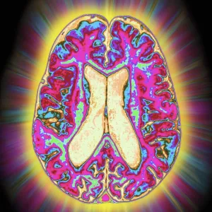 Coloured MRI scan of organophosphate brain damage