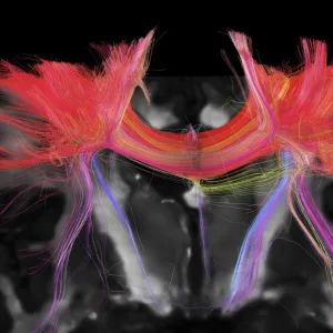 Corpus callosum, DTI MRI scan C017 / 7043