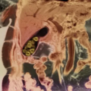 Gallstones, MRI scan