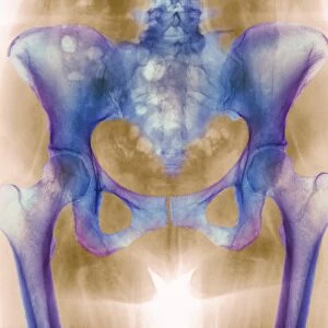 Healthy hip bones, X-ray