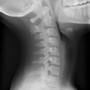 Healthy spine of the neck, X-ray