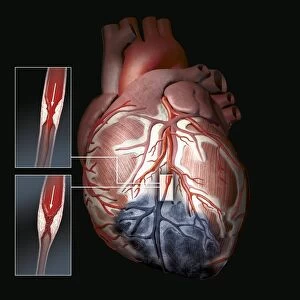 Heart ischaemia