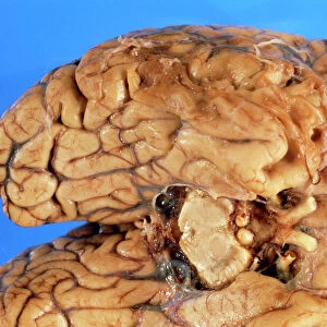 Human brain showing damage due to head injury