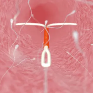 IUD contraceptive and sperm cells