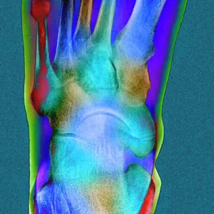 Normal foot, X-ray