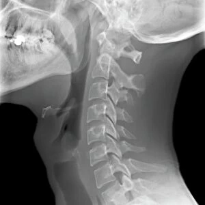 Normal neck, X-ray