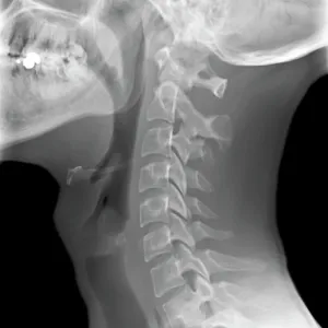 Normal neck, X-ray