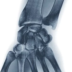 Normal wrist, X-ray