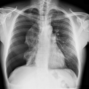 Pneumothorax, X-ray C017 / 7812