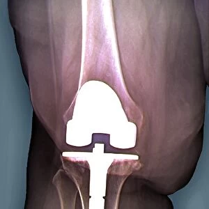 Prosthetic knee and obesity, X-ray C016 / 6595