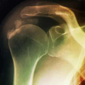 Tendinitis of the shoulder, X-ray