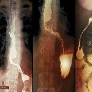 Throat cancer, X-rays