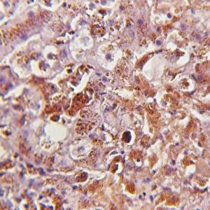 Liver tissue of patient suffering from diabetes