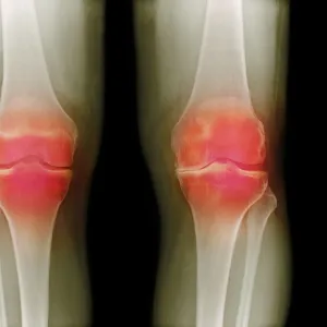 Arthritic knees, X-ray