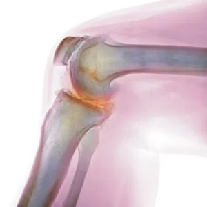 Arthritis of the knee, X-ray