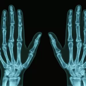 Hands, X-ray