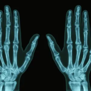 Hands, X-ray