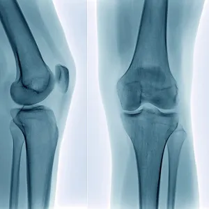 Healthy knee, X-ray