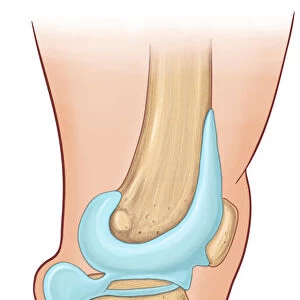 Lateral view of Bakers Cyst