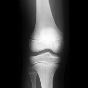 Normal childs knee, X-ray