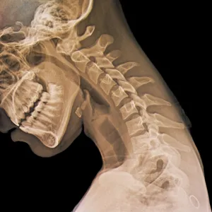 Normal flexed neck, X-ray