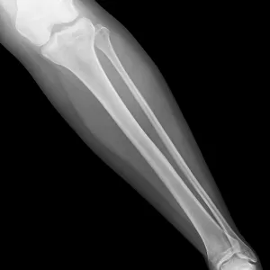Normal lower leg, X-ray