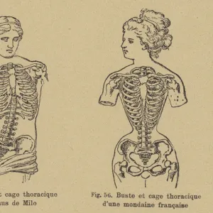 Comparison of the shape of the chest and ribcage of the Venus de Milo with that of a late 19th Century French socialite (engraving)