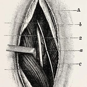 ligature of, femoral are the long saphenous nerve, medical equipment, surgical instrument