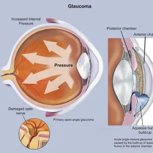 Retina of eye with glaucoma