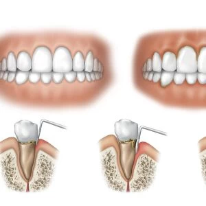 Three stages of periodontal disease