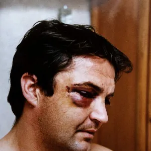 Gary Mabbutt Football shows off the bruising on his face from having his cheek jaw broken