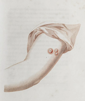 Immunology Gallery: Coloured depiction of lesion on arm