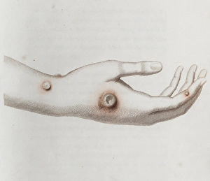 Immunology Gallery: Coloured depiction of lesion on a hand
