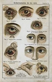 Phenomenon Gallery: Enfermedades de los ojos (Eye diseases). Engraving