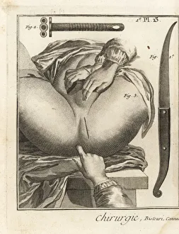 Foubert's surgical operation to remove a bladder stone Foubert's surgical operation to remove a bladder stone