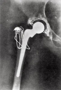 Inst. Of Mechanical Engineers Prints: X-ray Hip Joint Replacement Print