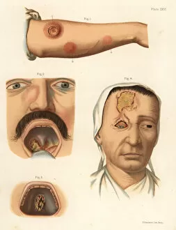 Medallion Gallery: Tertiary period syphilis symptoms on the body