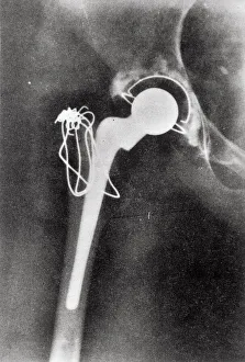 <b class=qtipBold><figcaption>X-ray hip joint replacement</figcaption></b><br>X-ray hip joint replacement Date:<br><em>© The Institution of Mechanical Engineers/Mary Evans</em> X-ray hip joint replacement