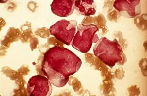 Stem Cell Gallery: Acute myeloid leukaemia, micrograph