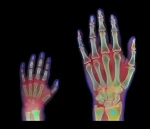 Images Dated 19th December 2000: Adult and child hand X-rays