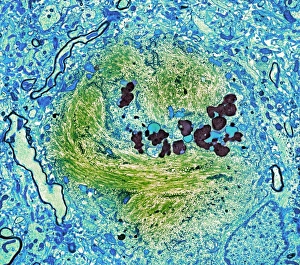 Alzheimers disease brain cell, TEM