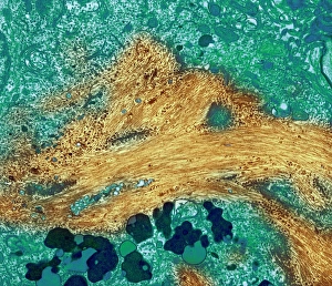 Alzheimers disease brain cell, TEM