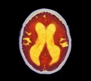 Images Dated 4th February 2004: Alzheimers disease brain, coloured CT scan
