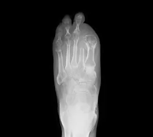 Xray Collection: Amputated toes, X-ray C017 / 7166